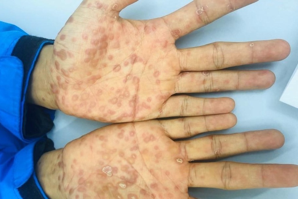 Bệnh nhân dưới 18 tuổi khám da liễu, nghi ngờ bị xâm hại tình dục - Ảnh 1.