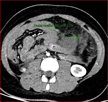 Bệnh viện Việt Nam - Cu Ba Đồng Hới thông tin ca bệnh hiếm gặp gây tử vong - Ảnh 2.