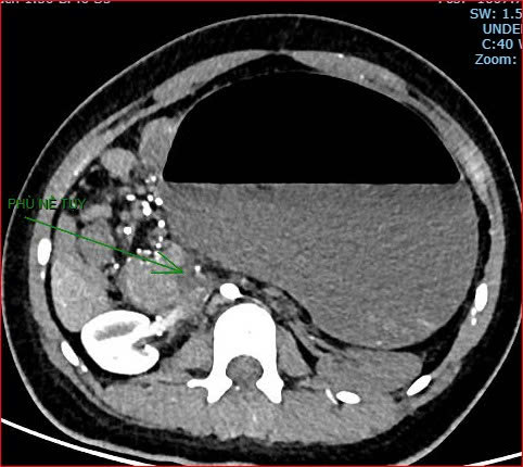 Bệnh viện Việt Nam - Cu Ba Đồng Hới thông tin ca bệnh hiếm gặp gây tử vong - Ảnh 3.