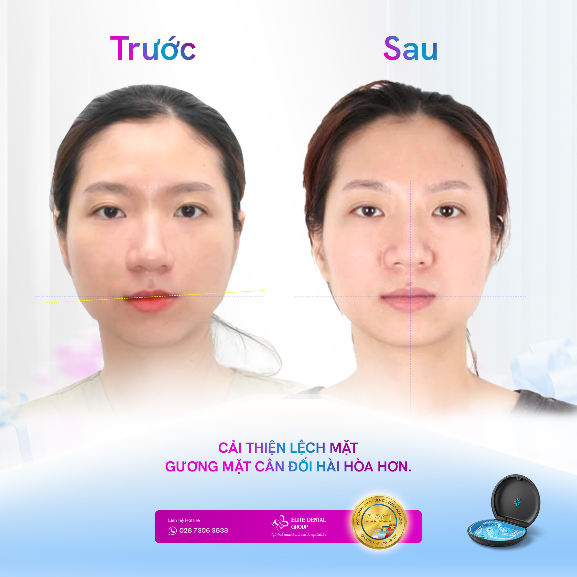 Khi niềng răng Invisalign không chỉ là “Niềng cho đều răng" - Ảnh 2.