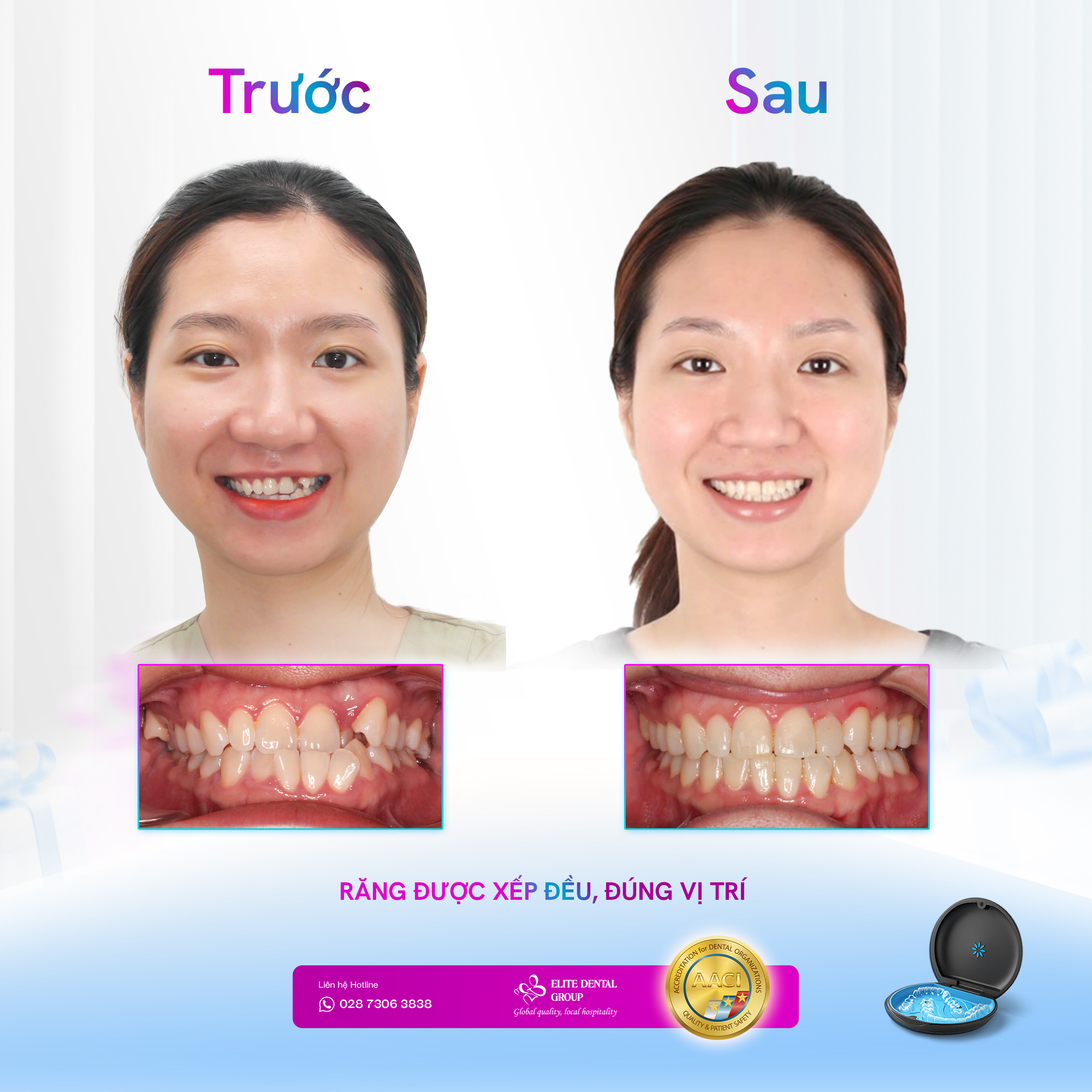 Khi niềng răng Invisalign không chỉ là “Niềng cho đều răng" - Ảnh 4.