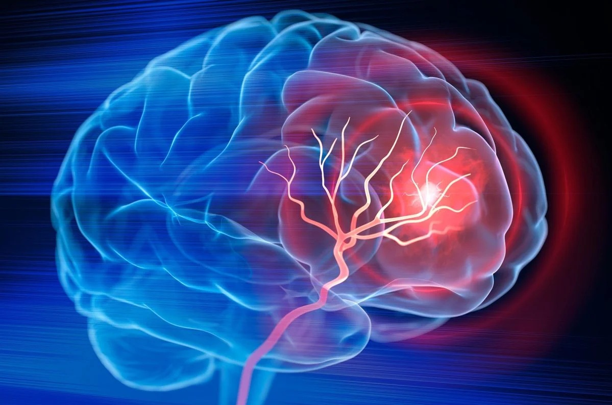 Mỹ phát triển phương pháp trị đột quỵ mới, chỉ cần 1 lần truyền dịch - Ảnh 1.