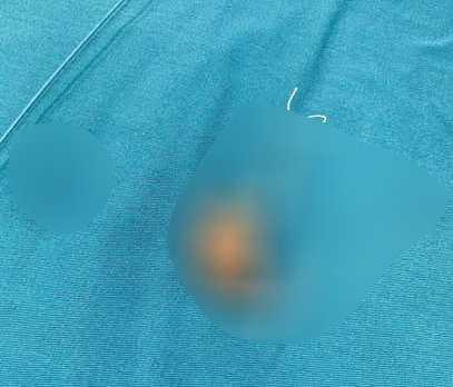 Người phụ nữ ở C&agrave; Mau ph&aacute;t hiện sự thật sau 22 năm đặt v&ograve;ng tr&aacute;nh thai - Ảnh 1.