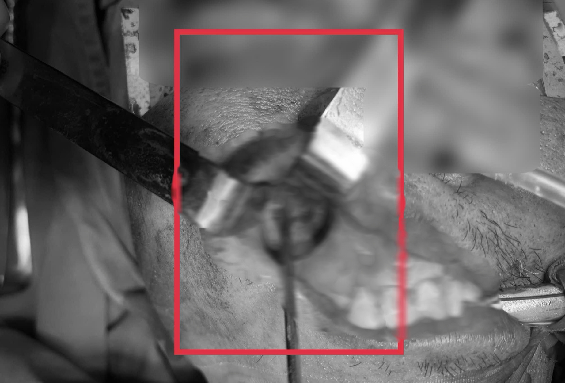 Nấm đen 'ăn' mòn xoang hàm người đàn ông khỏe mạnh  - Ảnh 1.