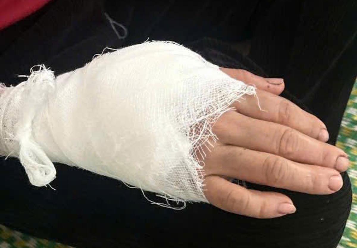 Khỉ đuôi lợn tấn công người phụ nữ khâu 15 mũi - Ảnh 2.