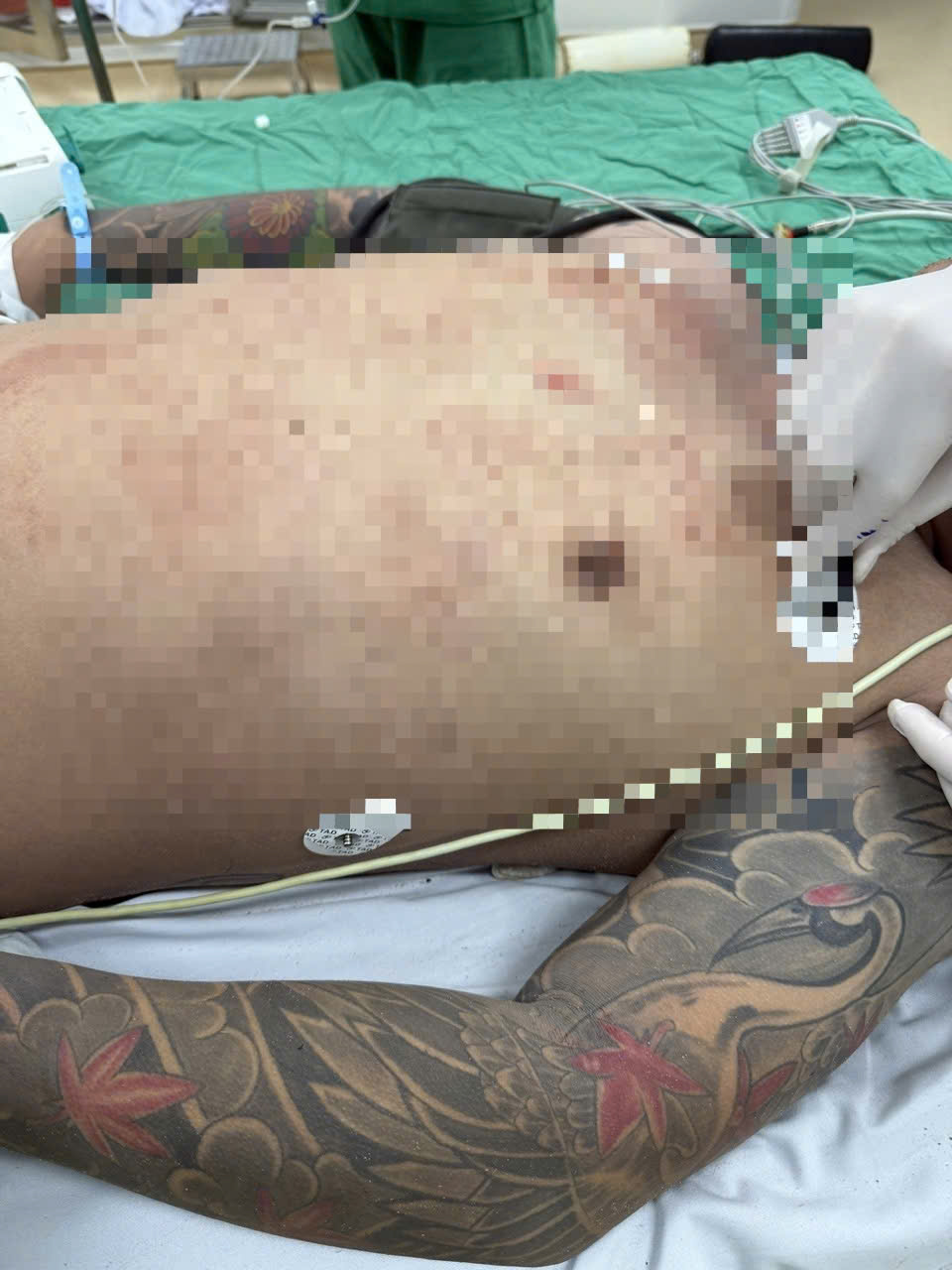 Cứu sống nam bệnh nhân bị thủng tim nguy kịch vào tối 26 Tết - Ảnh 1.