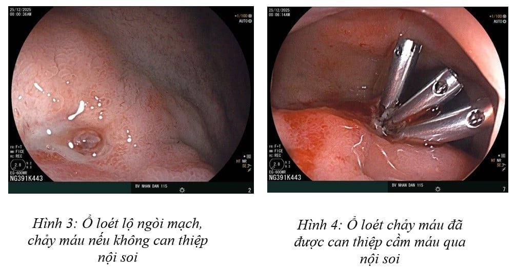 Xuất huyết dạ dày vì stress, ăn uống thất thường ở người trẻ  - Ảnh 1.