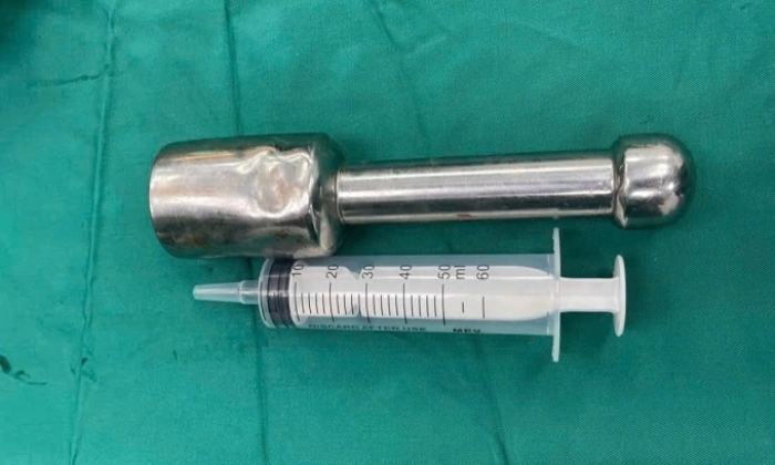 Thiếu niên 15 tuổi mắc kẹt chày kim loại dài 18 cm trong trực tràng - Ảnh 1.