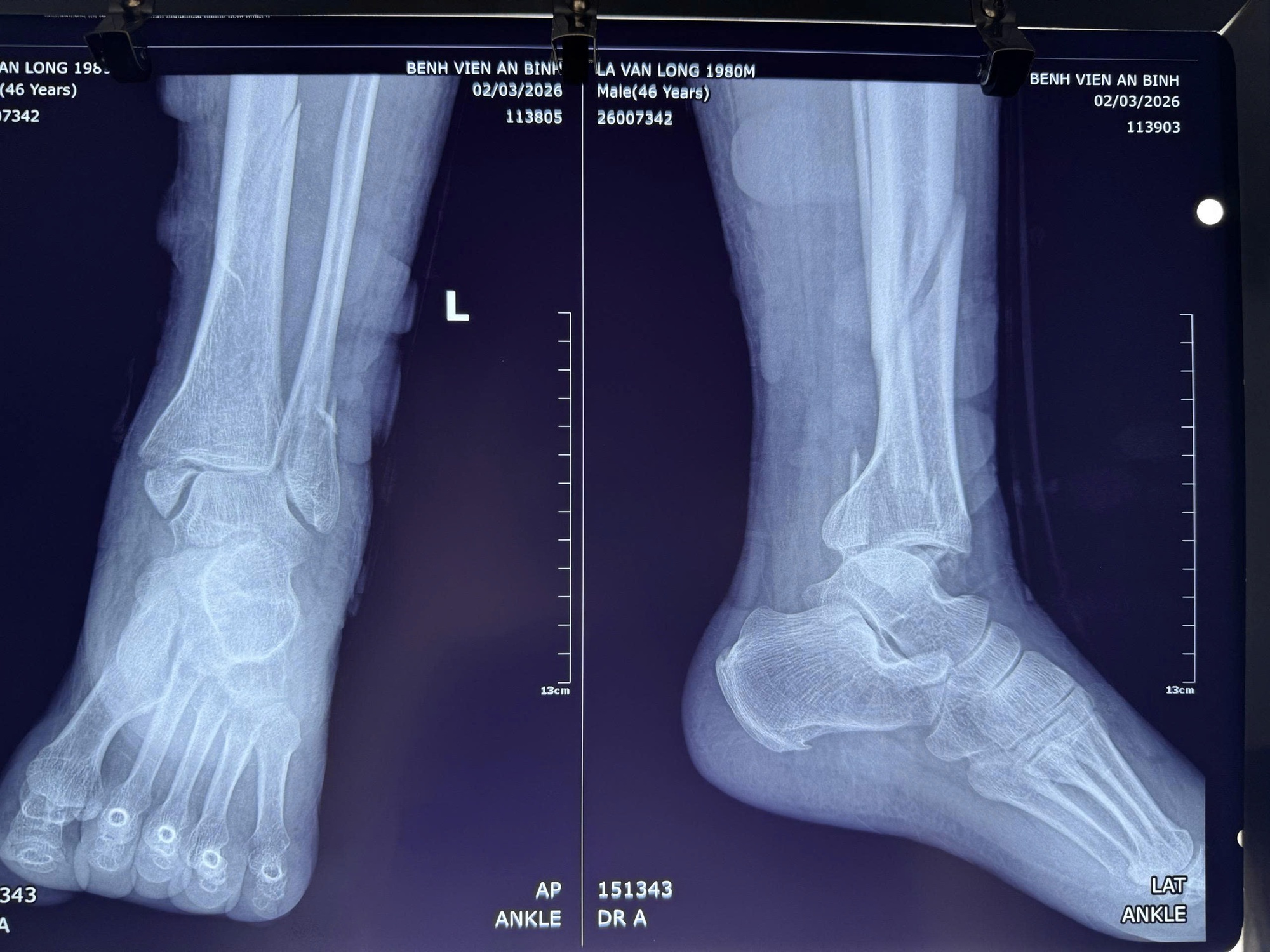 Đắp l&aacute;, một người đ&agrave;n &ocirc;ng su&yacute;t mất ch&acirc;n - Ảnh 2.