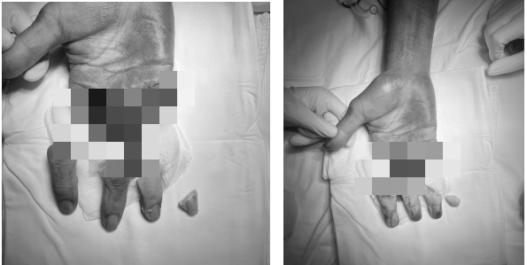 Tay bị máy cắt giấy làm đứt lìa 4 ngón, bệnh nhân được nối thành công - Ảnh 1.