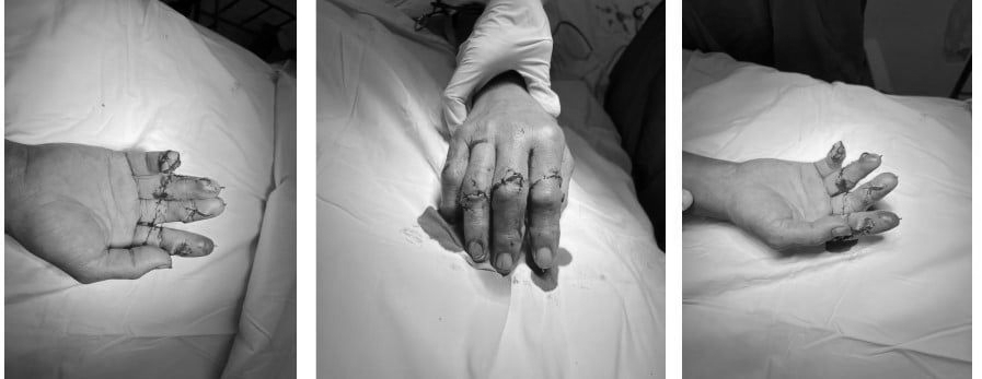 Tay bị máy cắt giấy làm đứt lìa 4 ngón, bệnh nhân được nối thành công - Ảnh 2.