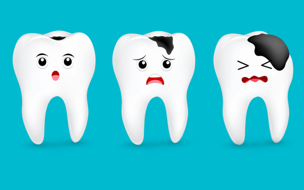 Răng bị s&acirc;u, &ecirc; buốt c&oacute; phải do thiểu sản men? - Ảnh 1.