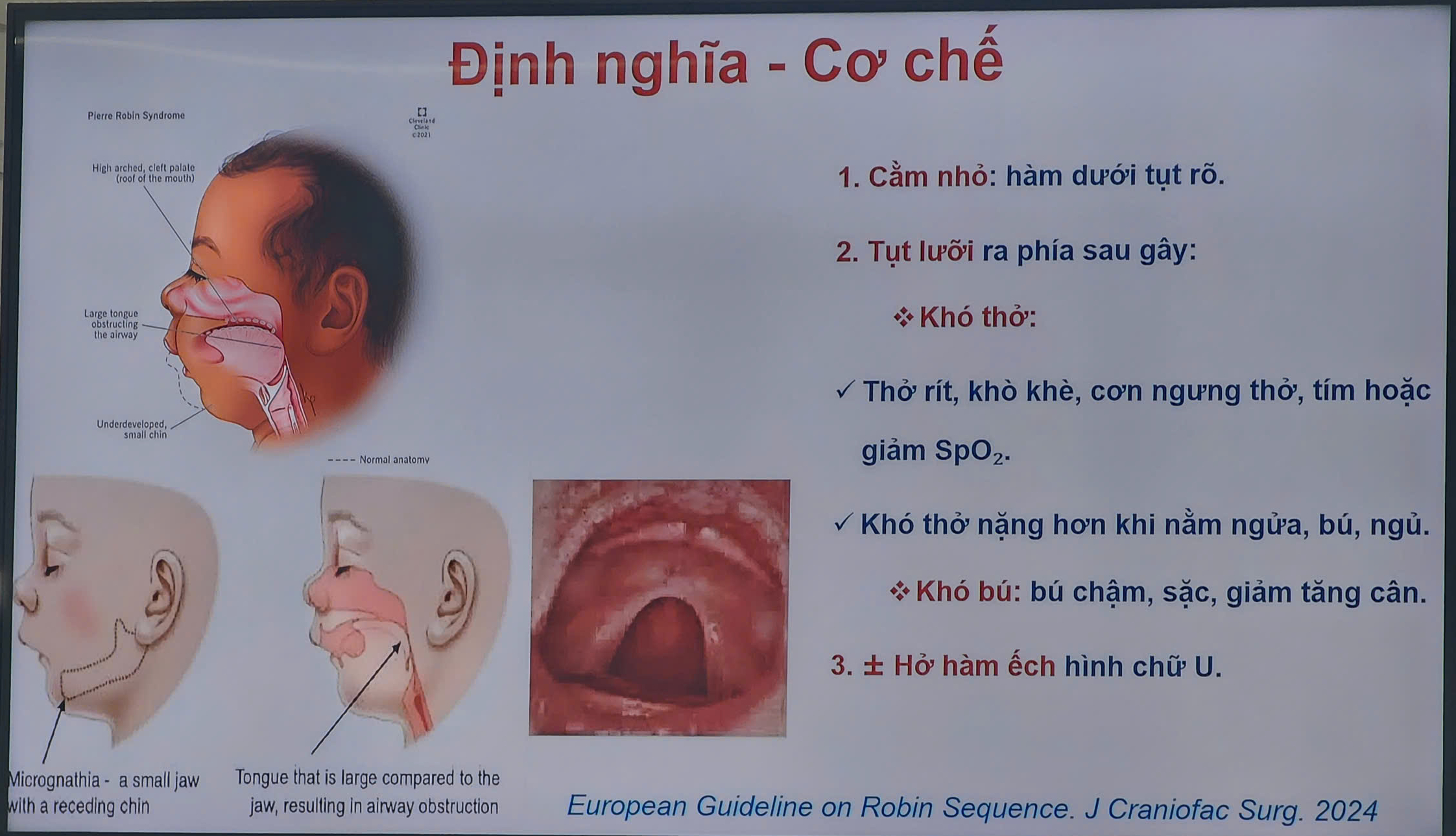 Khó thở sau sinh, tưởng bé chỉ bị đờm nhưng lại mắc hội chứng Pierre Robin - Ảnh 3.
