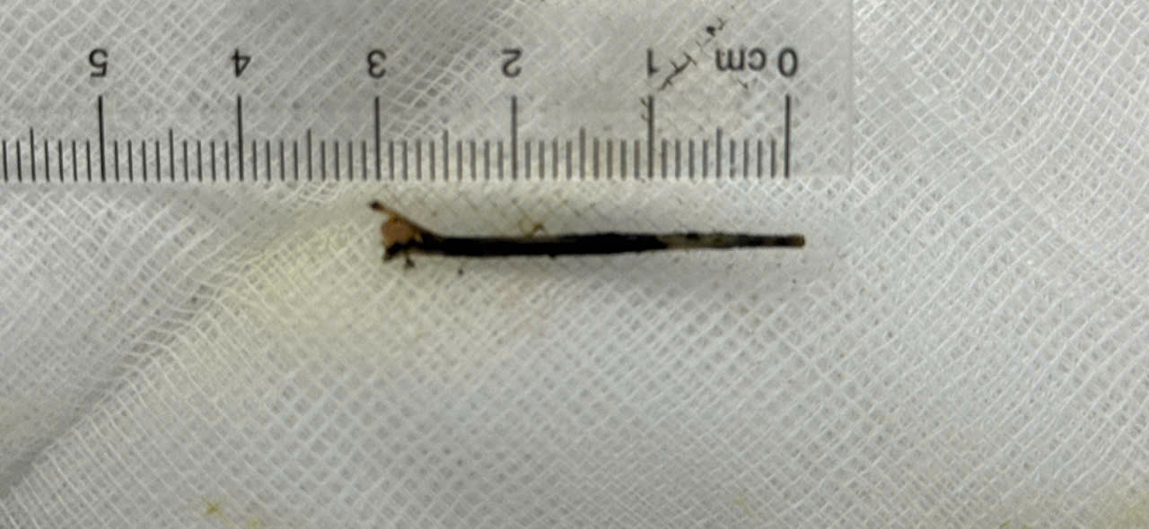 Mảnh xương cá là “thủ phạm” khiến người đàn ông ở Cần Thơ bị vàng da như… nghệ - Ảnh 2.