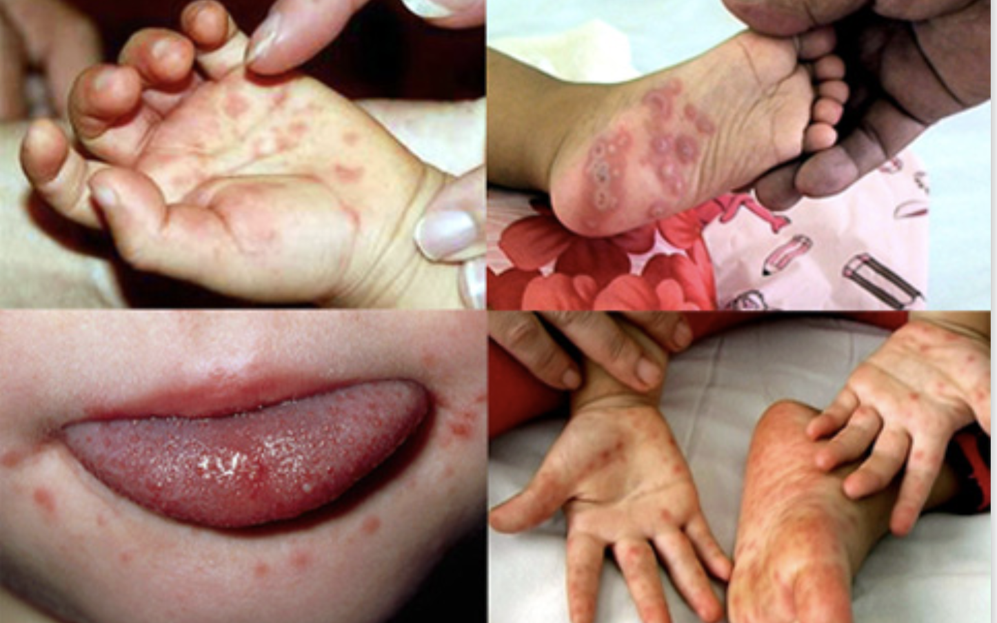 Dịch tay ch&acirc;n miệng &ldquo;n&oacute;ng&rdquo; trở lại, trẻ nhỏ đối mặt nguy cơ biến chứng nặng - Ảnh 3.