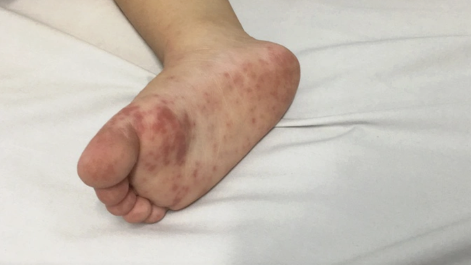 Dịch tay chân miệng tăng nhanh, đã ghi nhận 8 ca tử vong tại phía Nam - Ảnh 2.