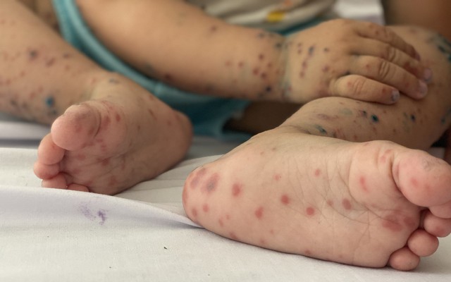 Bệnh tay ch&acirc;n miệng tăng nhanh, b&aacute;c sĩ cảnh b&aacute;o n&oacute;ng - Ảnh 2.