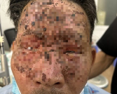 Nhiều người phải múc bỏ nhãn cầu vì pháo nổ ngày Tết - Ảnh 3.