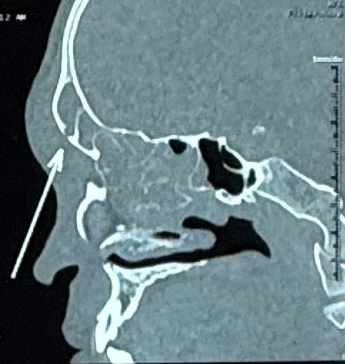 Tưởng chỉ viêm xoang đơn giản, nam thanh niên suýt mất mạng vì biến chứng - Ảnh 1.