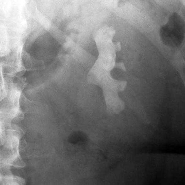 Bị sỏi thận có thể theo dõi tại nhà? - Ảnh 2.