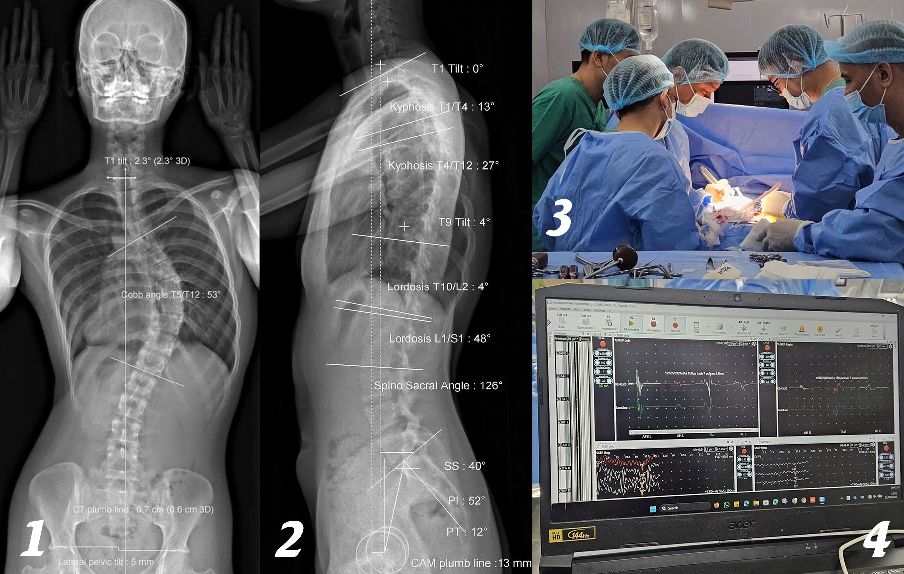 Soi gương thấy lưng có dấu hiệu lạ, cô gái 18 tuổi sốc khi biết cột sống đã cong 53 độ - Ảnh 1.