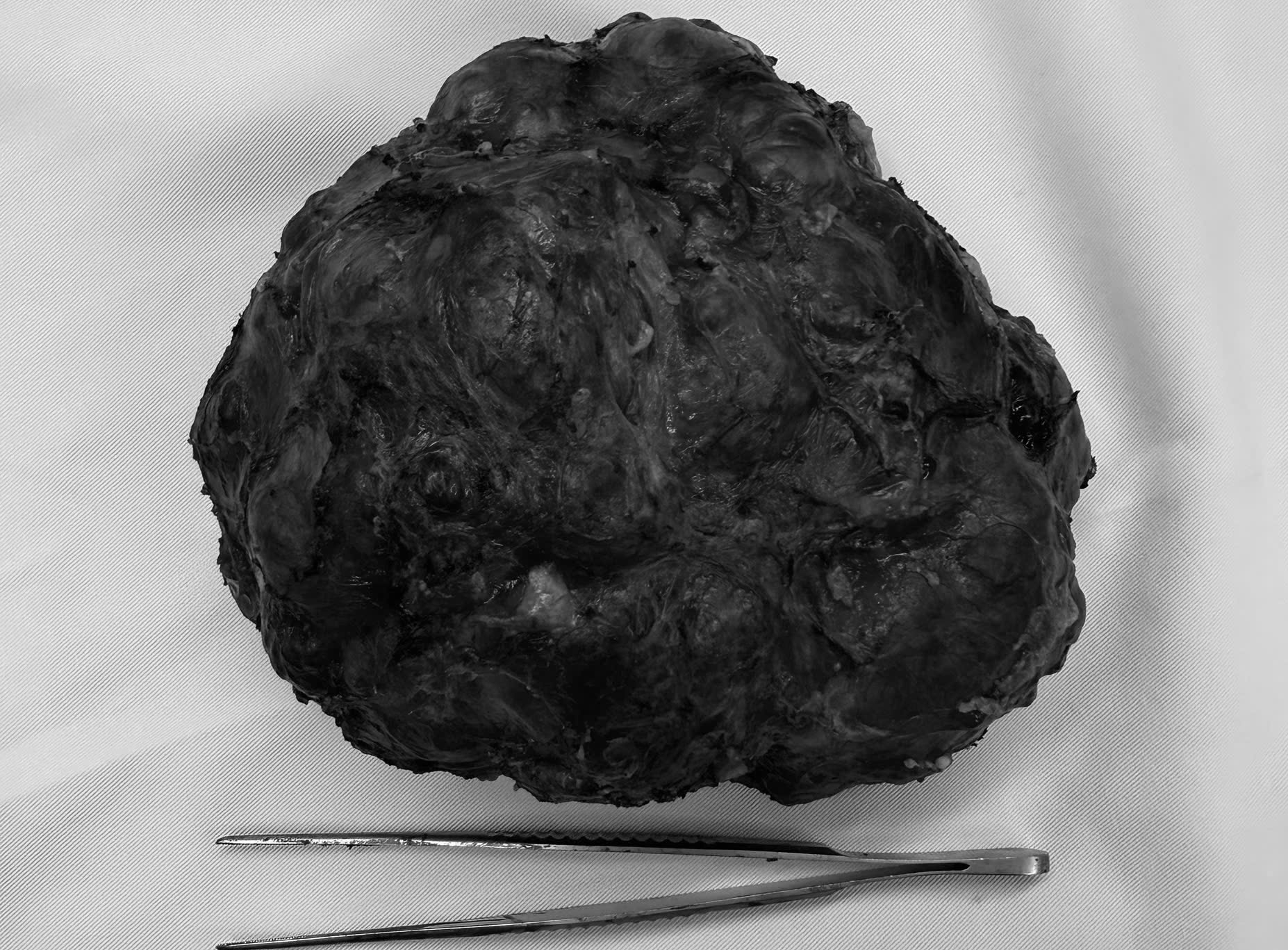 Du học sinh về nước mổ u tuyến vú 18 cm, bảo tồn toàn bộ tuyến vú - Ảnh 3.