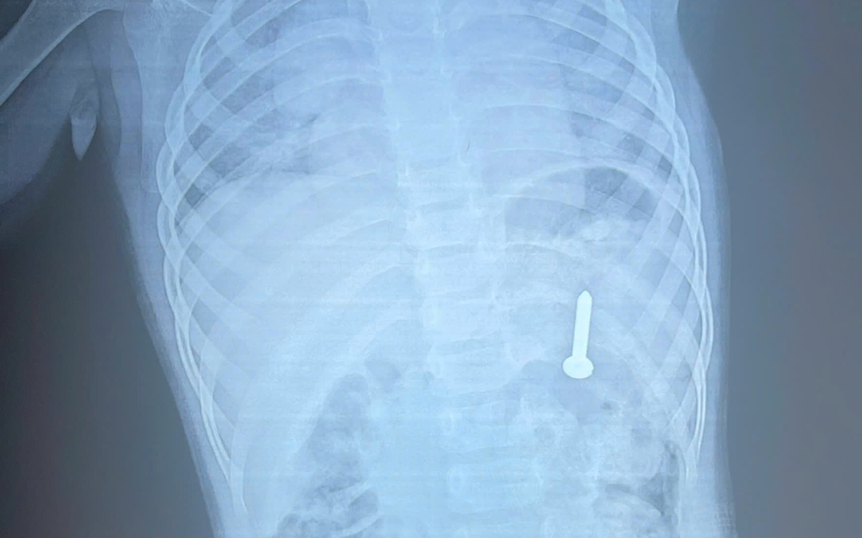 Hóc kẽm nhung dài 2cm, bé trai 3 tuổi phải mổ ngực khẩn cấp - Ảnh 3.