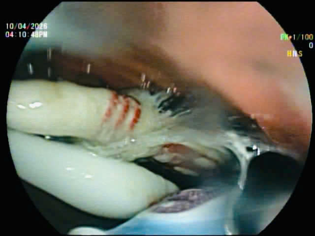 Người đàn ông nuốt cùng lúc 3 bàn chải đánh răng vào bụng - Ảnh 2.