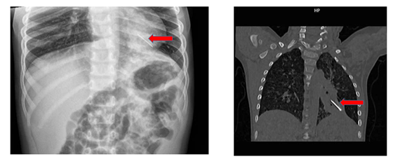 Hóc kẽm nhung dài 2cm, bé trai 3 tuổi phải mổ ngực khẩn cấp - Ảnh 1.
