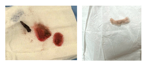 Hóc kẽm nhung dài 2cm, bé trai 3 tuổi phải mổ ngực khẩn cấp - Ảnh 2.