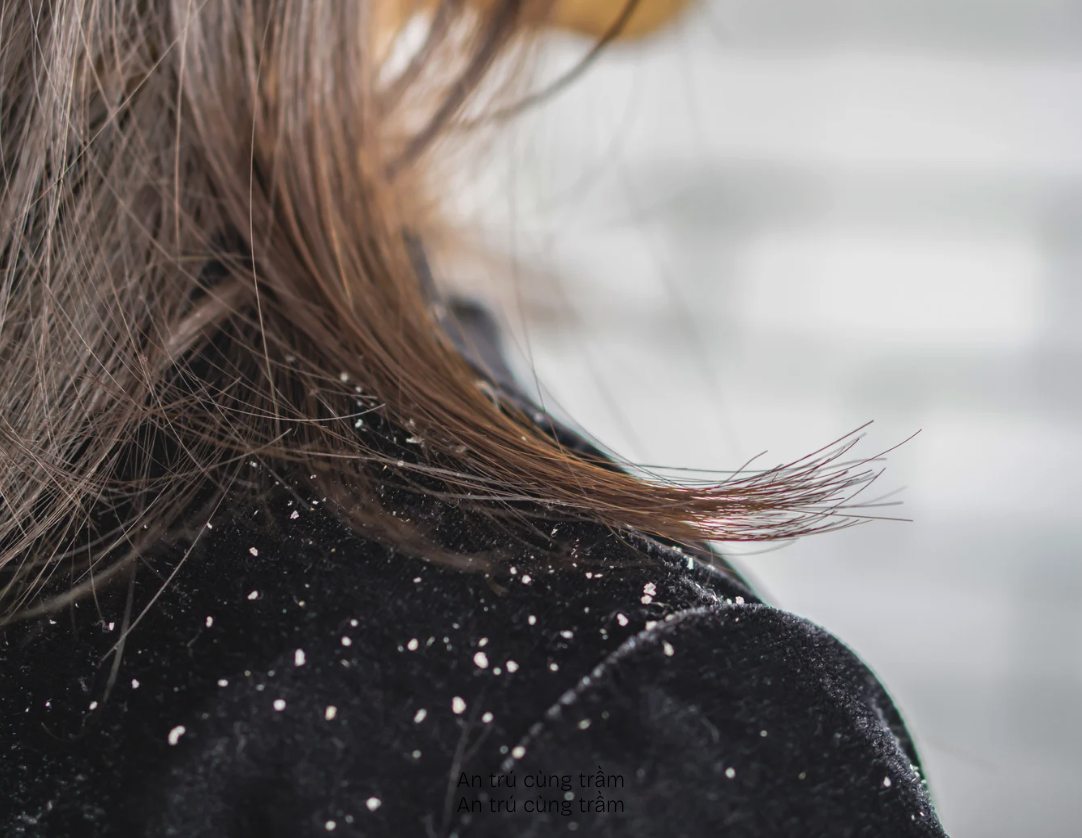 Cứ 100 người thì có 2 người bị gàu, nhưng đa số điều trị sai cách - Ảnh 2.