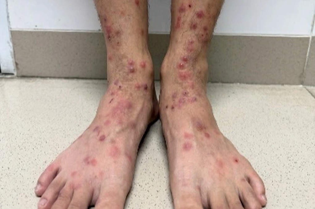 Sẩn ngứa do bọ chét - Ảnh 1.