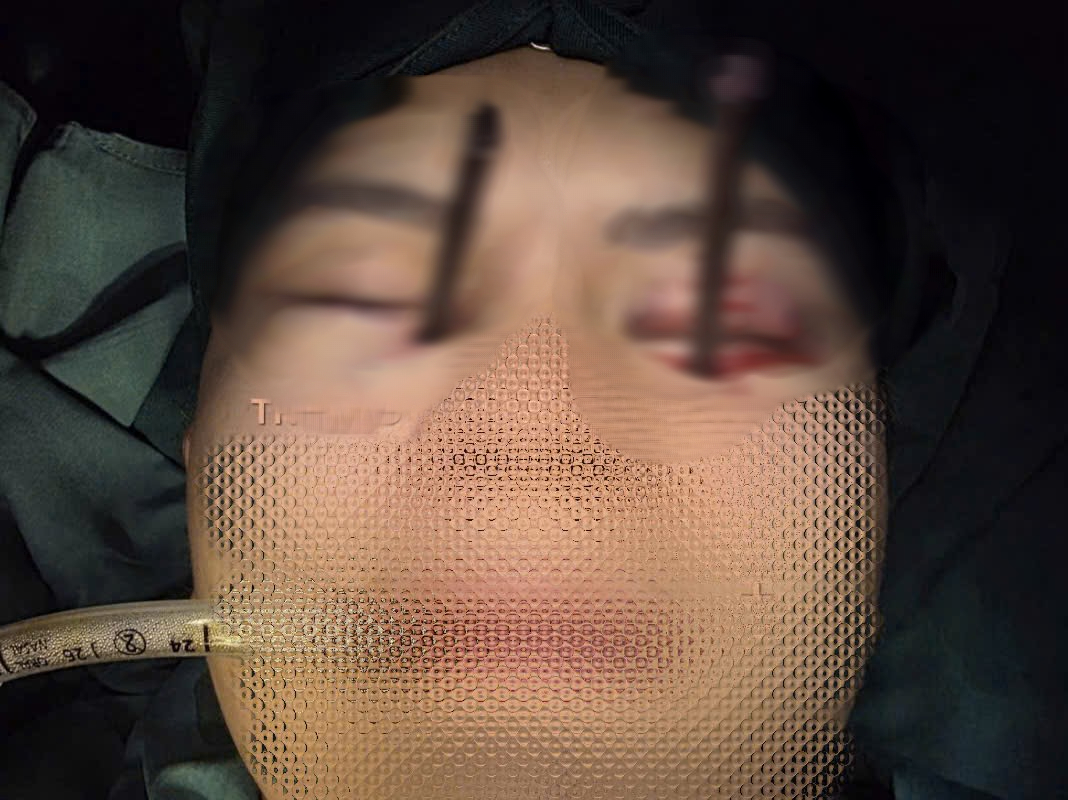 Cứu nam thanh niên bị dị vật đâm sâu hốc mắt - Ảnh 1.