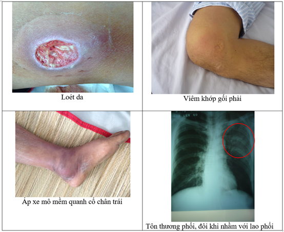 Bệnh vi khuẩn "ăn thịt người" thực chất l&agrave; g&igrave; sau khi Th&aacute;i Lan c&ocirc;ng bố 23 ca tử vong? - Ảnh 1.