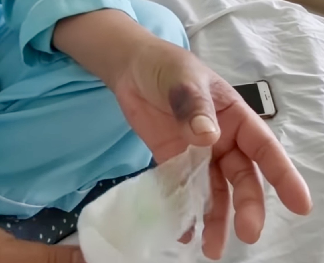 Bệnh viện báo động số ca rắn cắn tăng mạnh mùa hái điều - Ảnh 1.