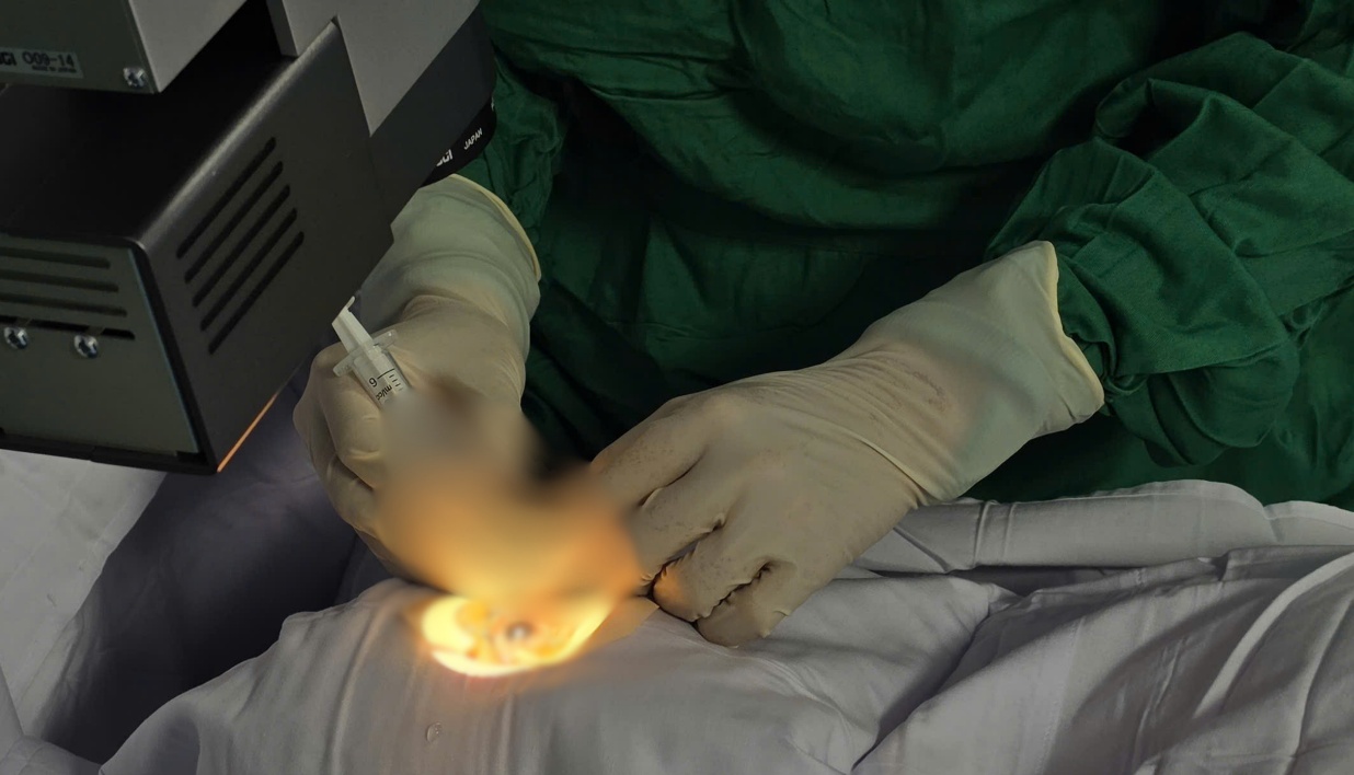 Một trường hợp cấp cứu hi hữu: bệnh nhân bị ong chích xuyên giác mạc - Ảnh 1.