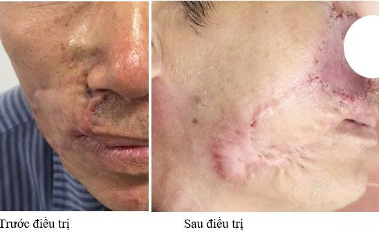 Ung thư da t&aacute;i ph&aacute;t sau nhiều lần mổ, khối u &acirc;m thầm lan rộng - Ảnh 1.