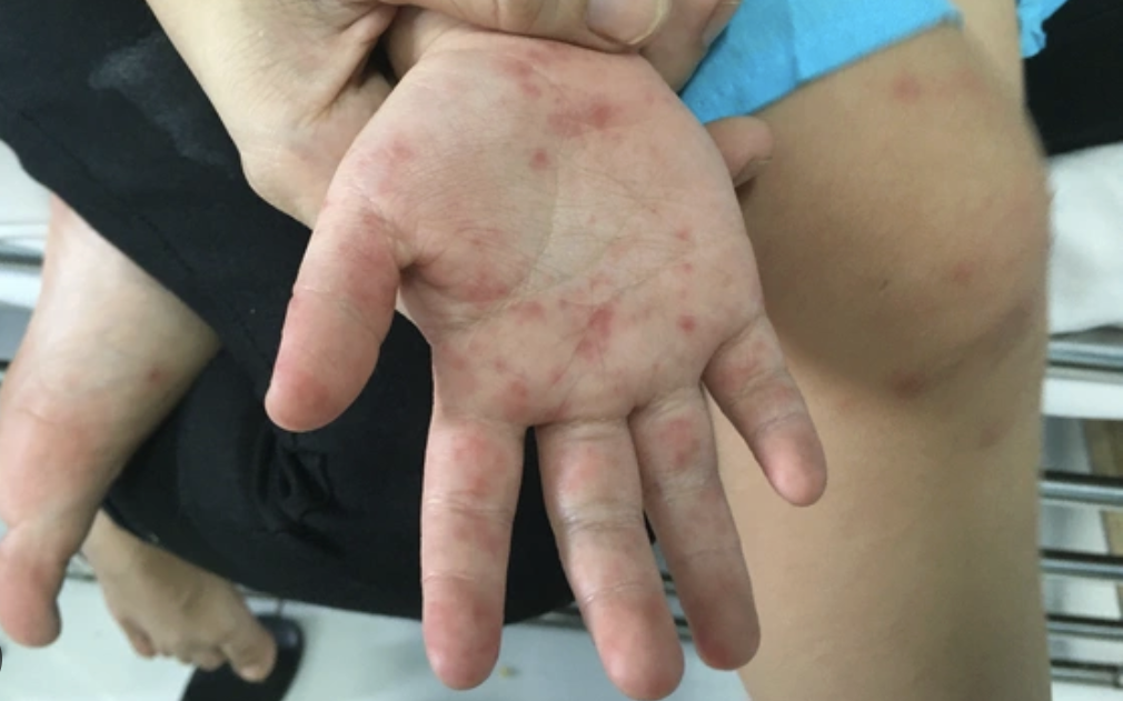 Không có ban rõ rệt, vì sao trẻ vẫn có thể mắc tay chân miệng thể nặng, thậm chí nguy kịch? - Ảnh 2.
