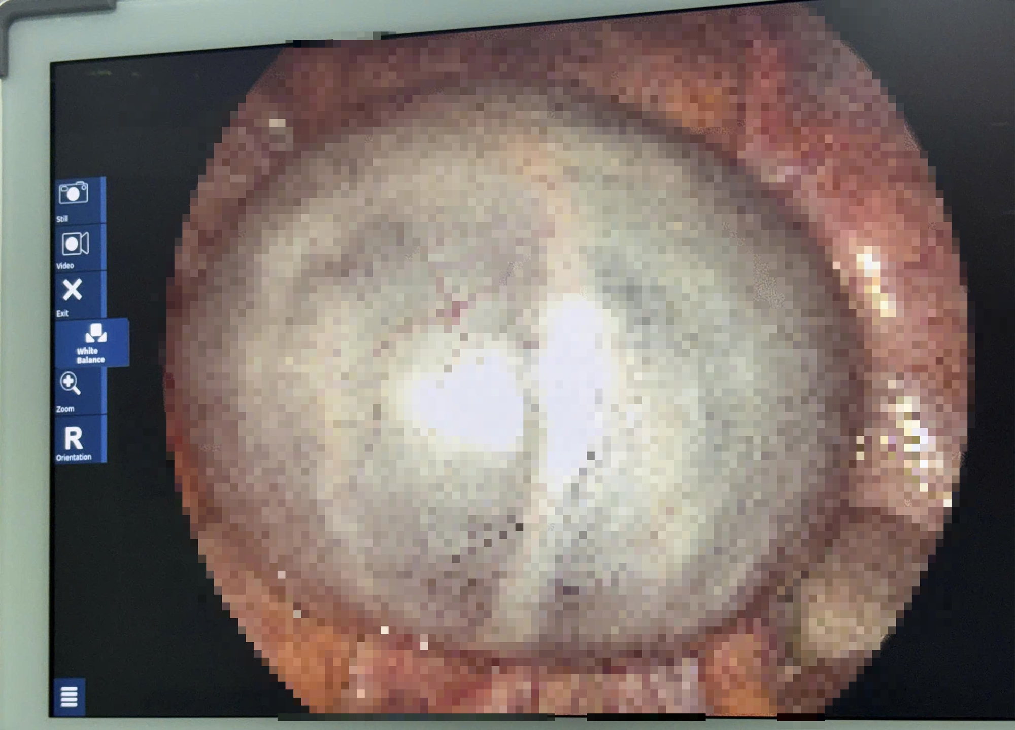 Khối u dài cả gang tay trong bụng người phụ nữ trẻ - Ảnh 1.