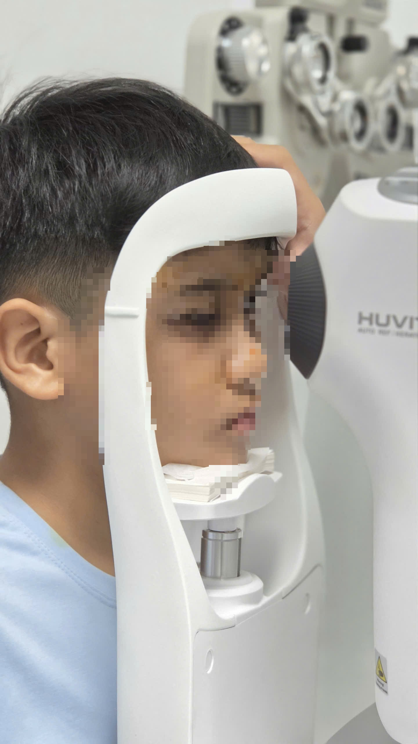Trường hợp hy hữu: Một bé trai 10 tuổi bị đục thủy tinh thể 2 mắt - Ảnh 2.