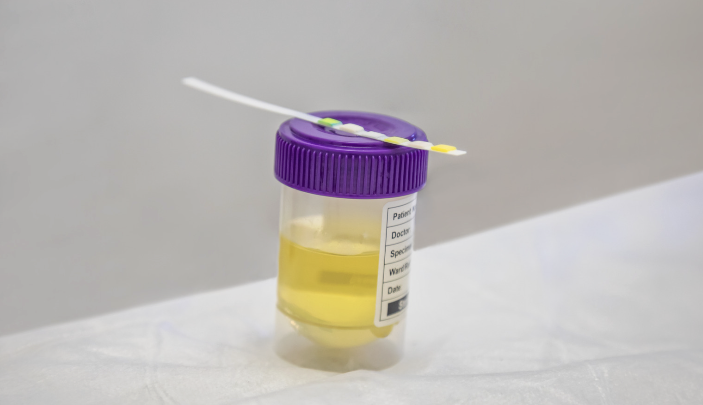 Nhiều phương pháp xét nghiệm ma túy, nhưng test nhanh chỉ mang tính sàng lọc - Ảnh 2.