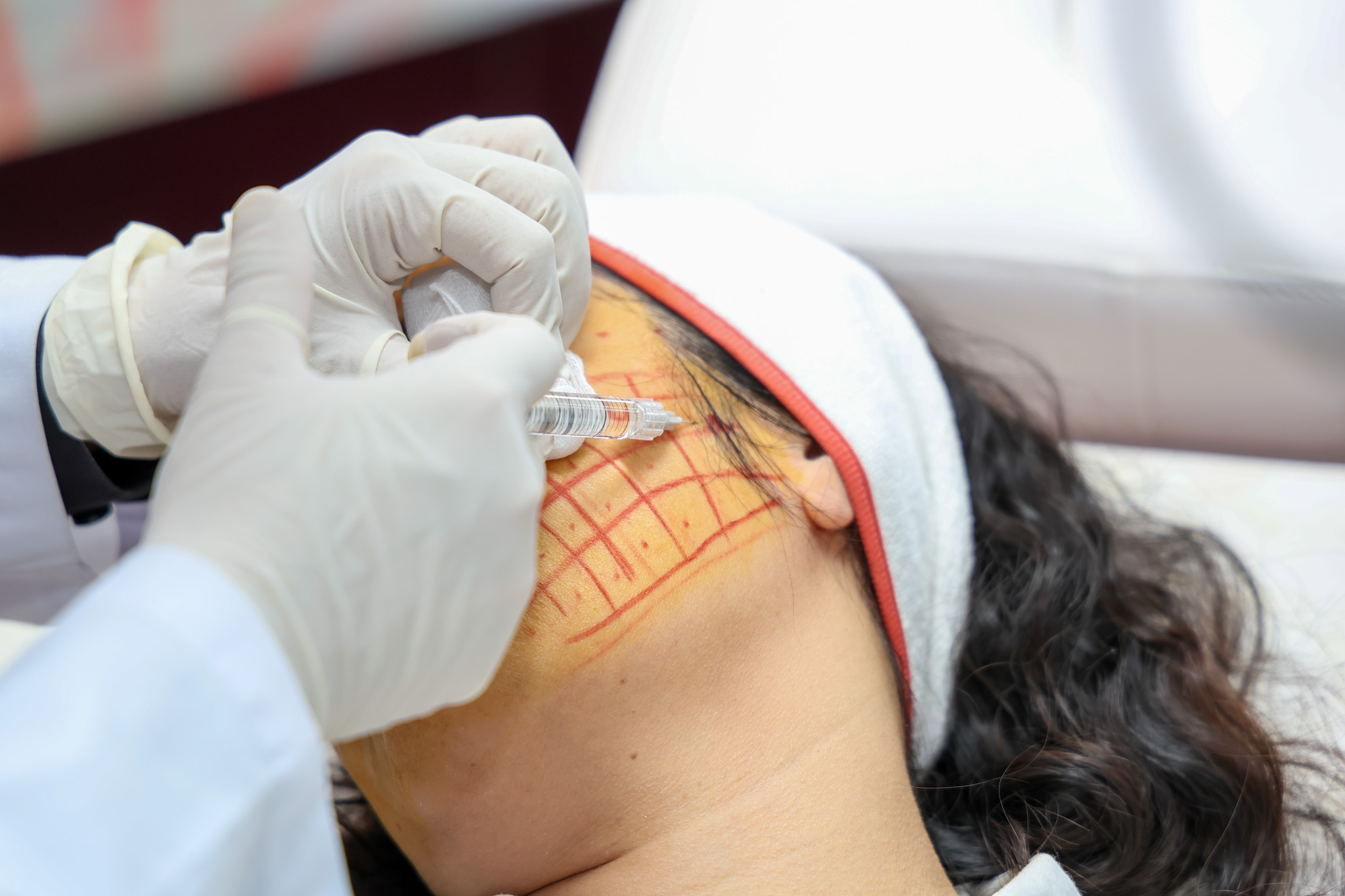 Làm đẹp bằng căng chỉ, cô gái nhập viện lấy dị vật - Ảnh 2.