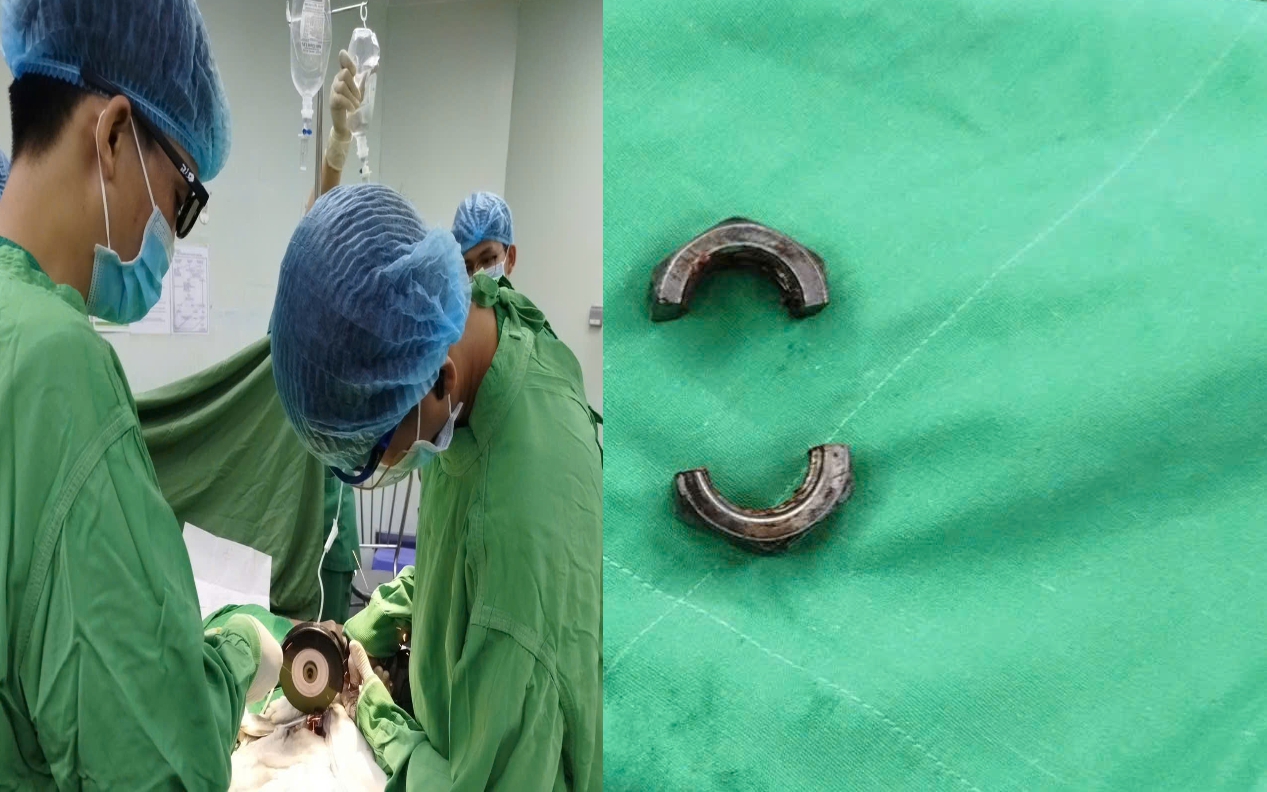 Người đ&agrave;n &ocirc;ng gặp nạn v&igrave; &ldquo;n&acirc;ng cấp dương vật&rdquo; đ&atilde; được xuất viện - Ảnh 1.