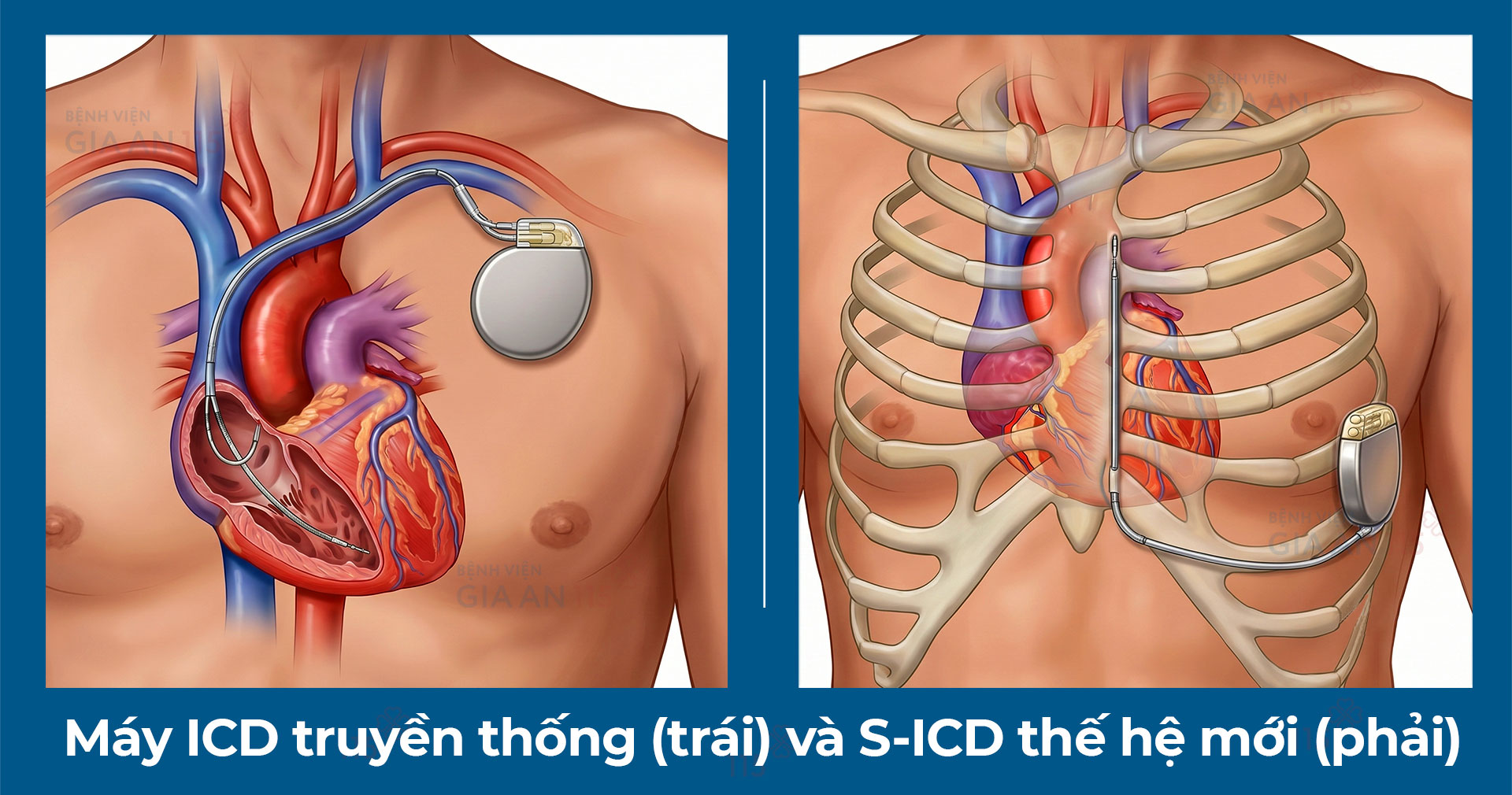 Lần đầu tiên đặt máy phá rung tim công nghệ mới - Ảnh 2.