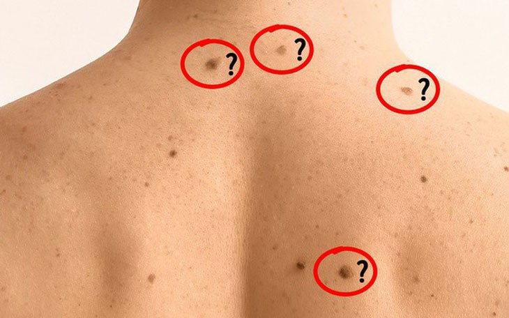 Người đ&agrave;n &ocirc;ng tưởng chỉ đau bao tử n&agrave;o ngờ bị ung thư dạ d&agrave;y - Ảnh 2.