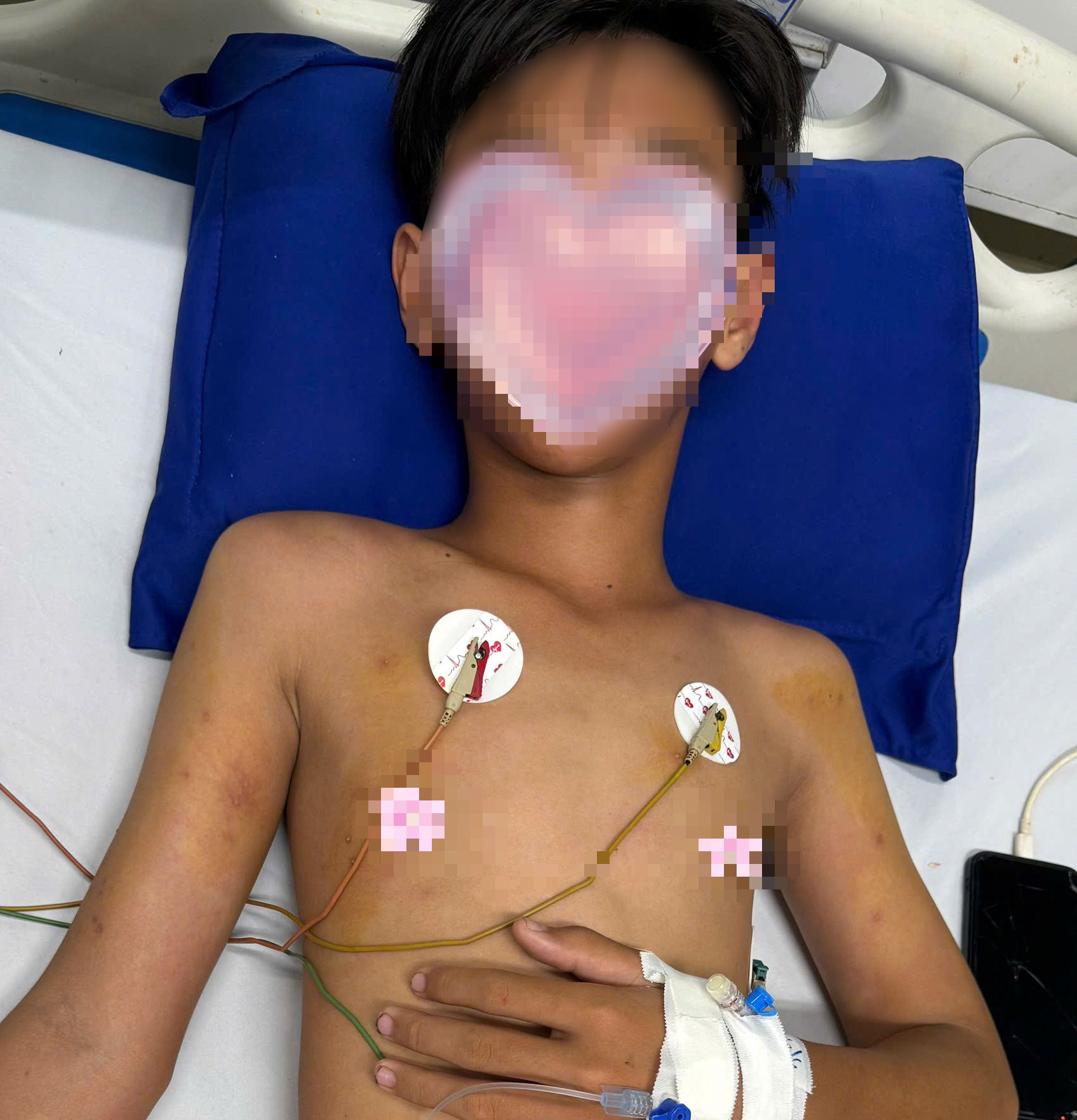 Bệnh nhi 14 tuổi ở Cà Mau bị ong vò vẽ đốt hàng chục vết - Ảnh 1.
