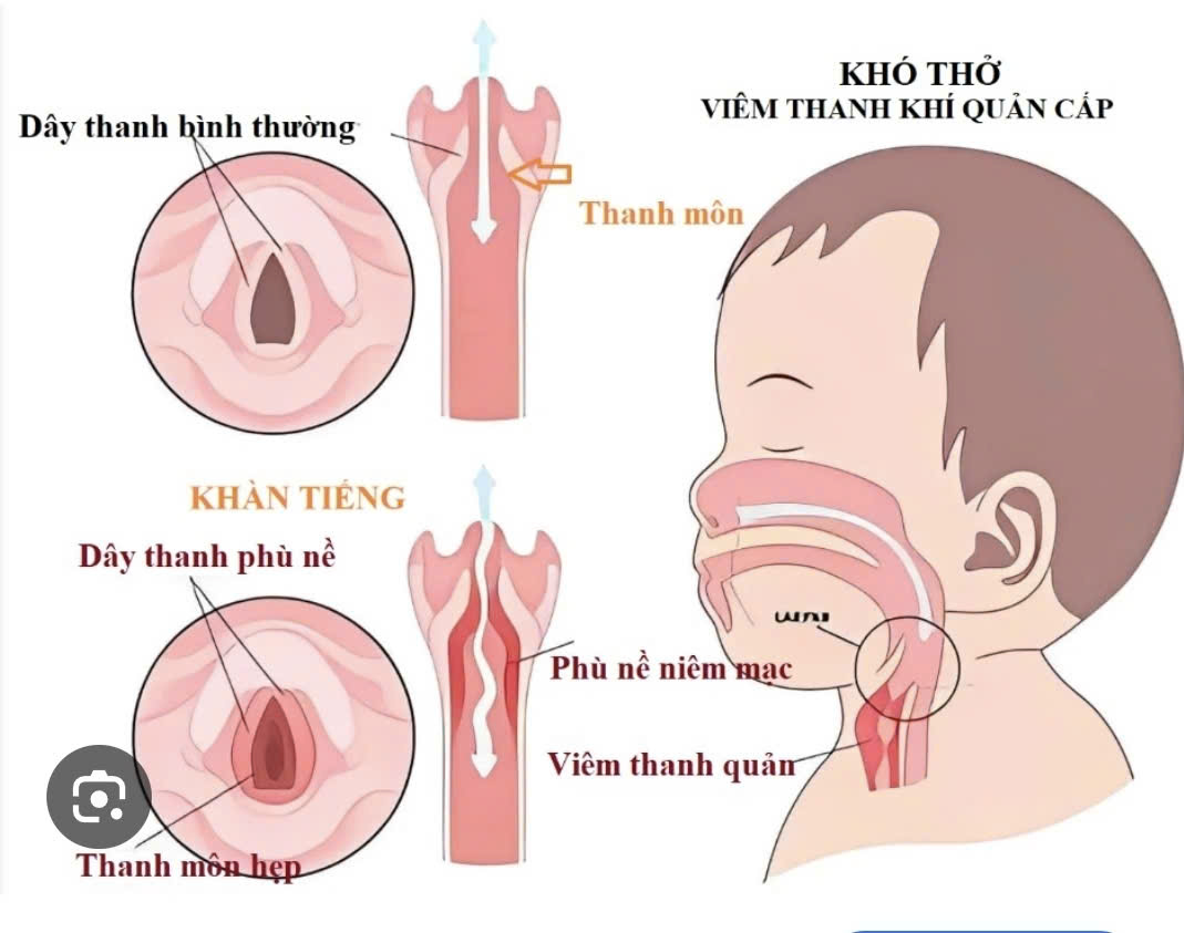 Sai lầm của cha mẹ làm trẻ viêm thanh quản mùa hè - Ảnh 2.