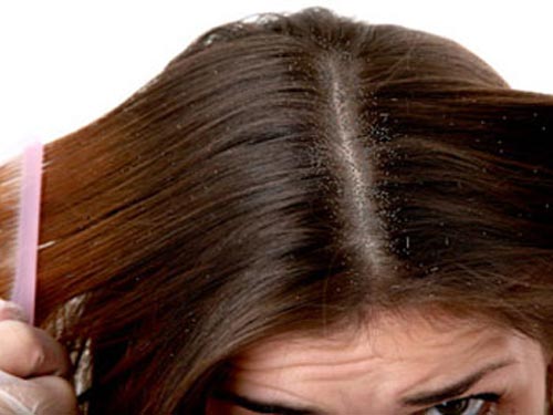 Rụng tóc gàu và nấm da đầu  Bệnh gì  VTVVN