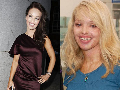 Katie Piper tái sinh sau thảm họa acid