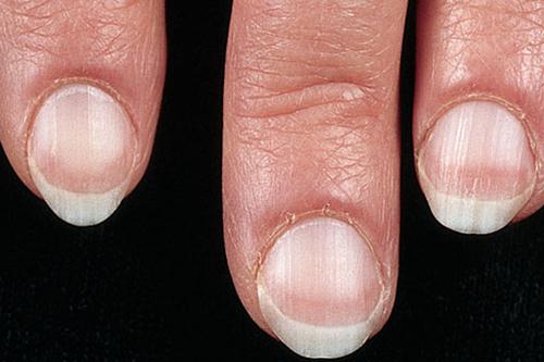 Bạn biết rằng bệnh cũng có thể phát hiện qua màu sắc của móng tay không? Xem ngay bức ảnh này để có thêm kiến thức về các dấu hiệu bệnh qua màu sắc móng tay và cách phòng tránh bệnh tốt hơn.